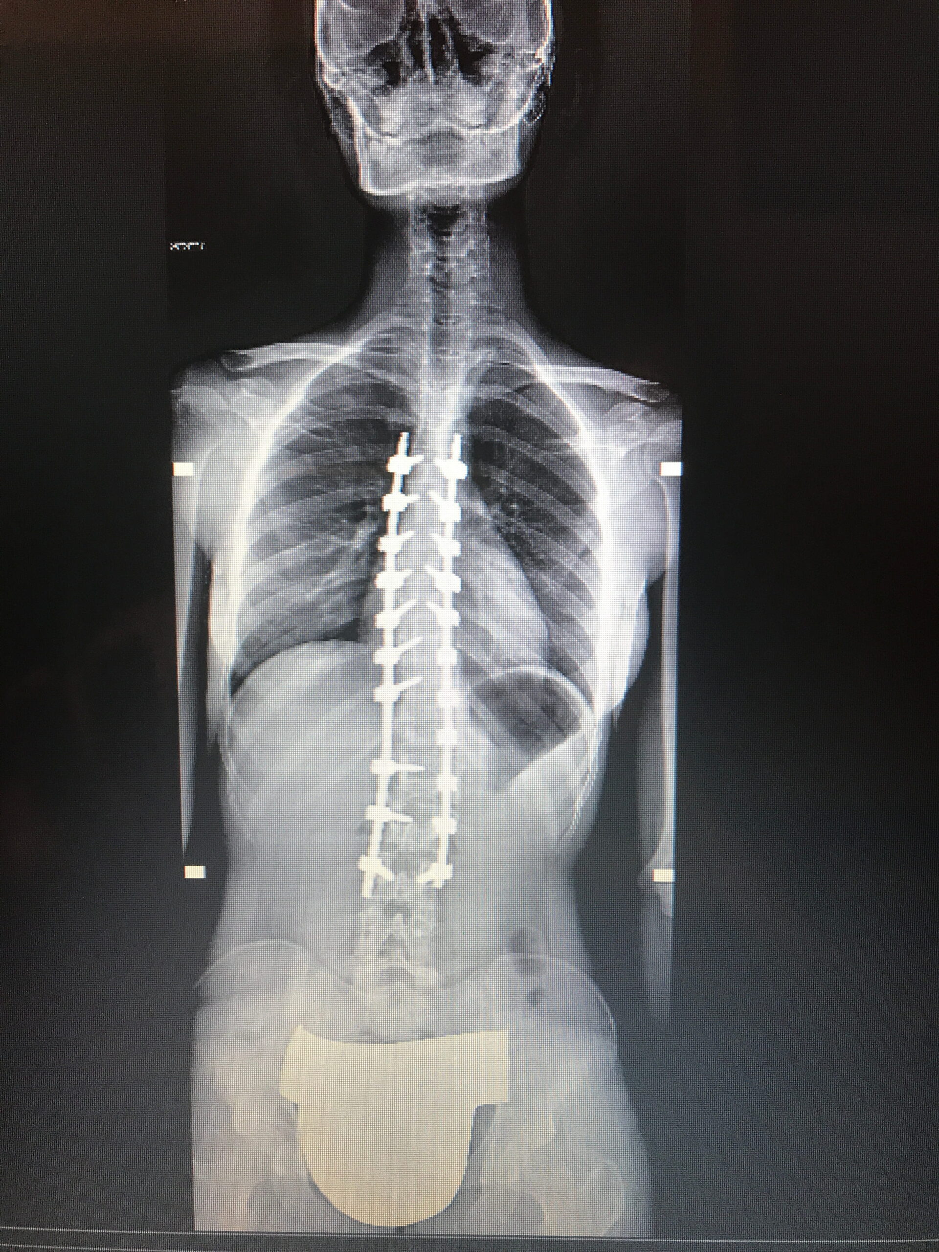 Radiografia della colonna con 21 viti